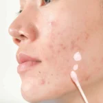 Anti-Acne Lotion - Image 4